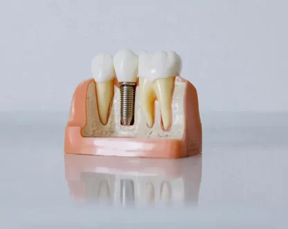 Thinking About Dental Implants in Paterson? Here’s Everything You Need to Know